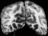 Hemorrhagic necrosis, posterior cerebral artery circulations, bilateral
